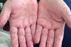 Від кору помер 49-річний житель Рівненщини