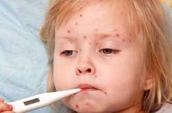 6 вихованців дитсадка в Солом'янському районі захворіли на кір