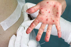 С начала года в Украине от кори умерло уже шесть человек