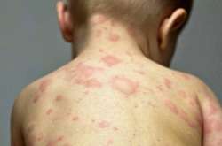 Кір страшний своїми ускладненнями