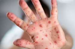 На Київщині за місяць на кір захворіло понад півтисячі осіб