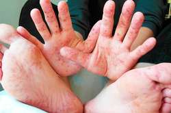 Більшості дітей вже зробили щеплення від кору або ж вони вже перехворіли і мають імунітет, - лікар