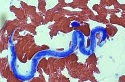 У чотирьох жителів Херсона з-під шкіри витягли величезних глистів