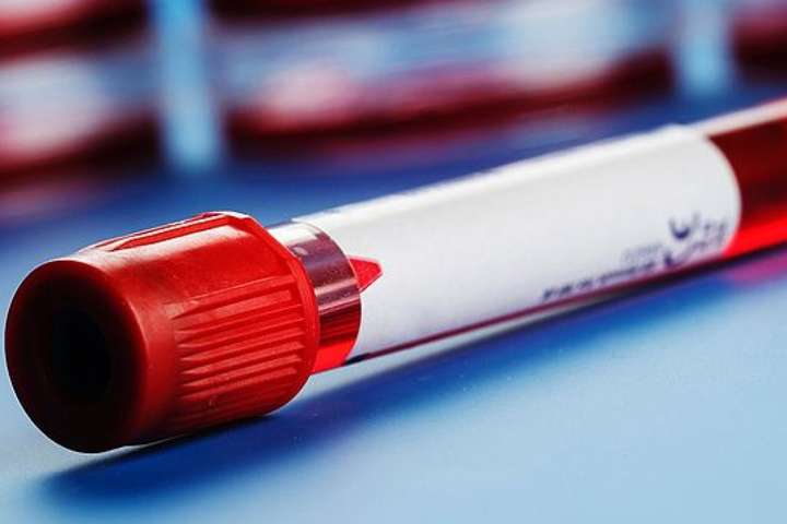На Одещині за тиждень зафіксовано три спалахи гепатиту A