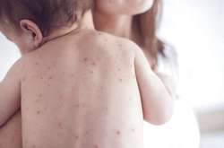 З початку року на кір захворіли вже близько 24 тисячі українців