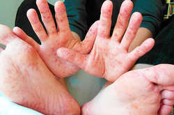 Украина вышла на первое место в мире по заболеваемости корью