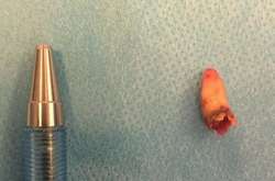 У мешканця Данії лікарі знайшли в носі зуб 