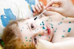 У Броварах спалах скарлатини та вітрянки 