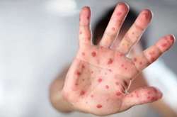 На Львівщині захворюваність на кір знизилася на 60%