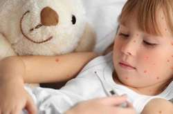 Понад 50 тис. школярів мають тільки одне щеплення проти кору в анамнезі чи взагалі не мало жодного