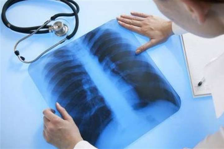 У МОЗ запевняють, що в Україні значно зменшилася кількість хворих на туберкульоз 