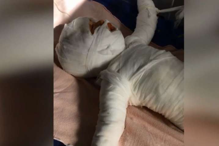 На Одещині немовля впало у відро з окропом. Медики борються за життя дитини