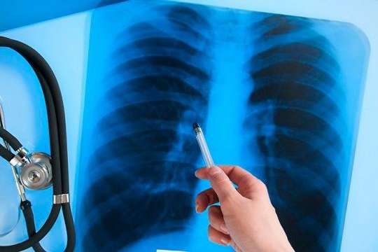 10 украинцев ежедневно умирает от туберкулеза