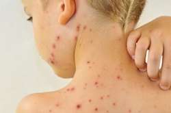 Від початку року на кір захворіли майже 33 тисячі українців