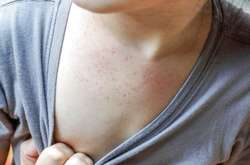 Стюардеса заразилася на кір від пасажира і опинилась у комі