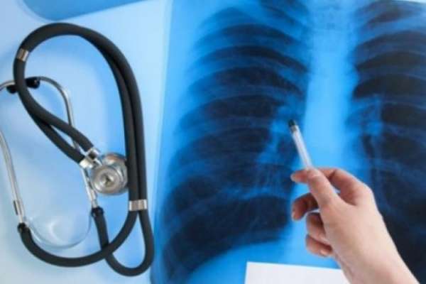 В Одесі знизилася смертність від туберкульозу