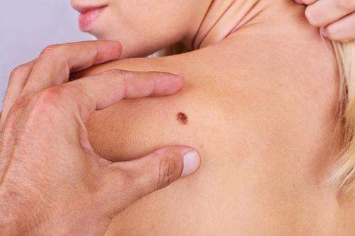 У п’ятницю кияни можуть безкоштовно перевіритися на рак шкіри