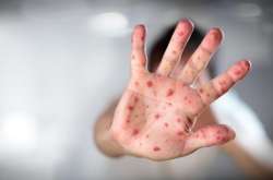 З початку цього року&nbsp;від ускладнень кору померло 16 людей