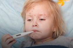 У Вінницькій області кількість захворілих на кір зменшилася на 43,5%