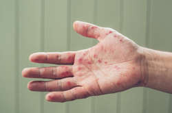 На початку травня в Україні різко зросла захворюваність на кір