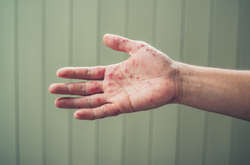 Корью в Украине с начала года заболели 54 тыс. человек