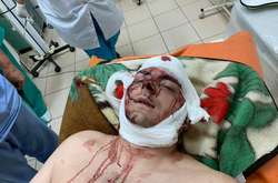 Названо основні версії замаху на колишнього мера Конотопа Семеніхіна