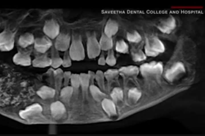 В Індії лікарі знайшли в роті у семирічного хлопчика 526 зубів (відео)