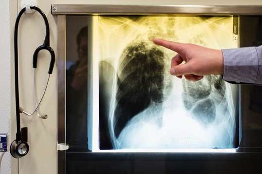 У Німеччині 109 осіб в одній школі заразилися туберкульозом