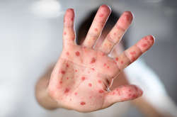 В Киеве зафиксирована самая масштабная вспышка кори с 1991 года