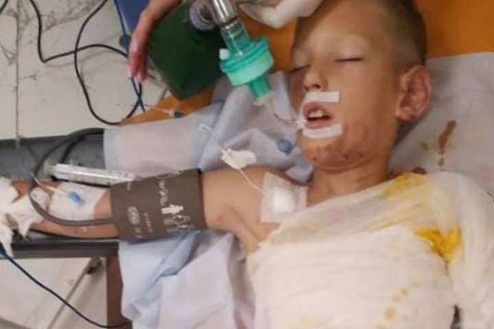 Недитячі ігри: у Дніпрі восьмирічного хлопчика облили бензином і підпалили