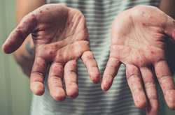 Кір зафіксовано іще в чотирьох країнах Європи 