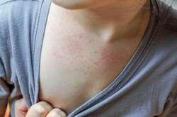 Протягом 36-го тижня 2019 року (з 29 серпня по 5 вересня) на кір захворіли 153 людини - 92 дорослих і 61 дитина