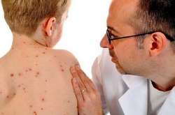 Найбільше нових випадків захворювання на кір зареєстровано в Київ, Дніпропетровській, Одеській, Вінницькій та Київській областях