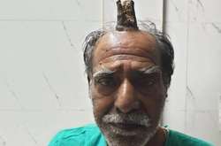 Мужчина жил с «дьявольской меткой»: у индуса вырос 10-сантиметровый рог