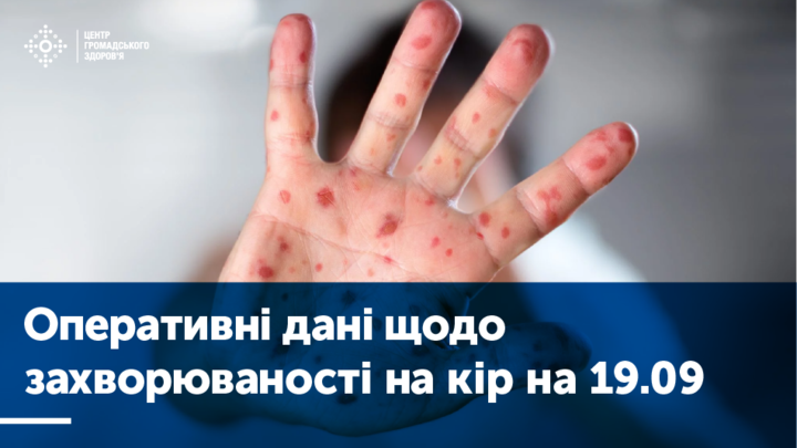 Втричі зросла кількість хворих на кір у Вінницькій області