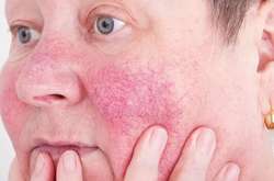 Все на лице: пять сигналов о нехватке витамина D