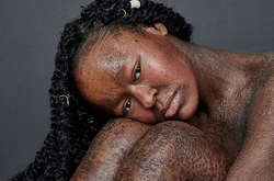 Модель с кожей «рептилии» ошеломила сеть своими фото