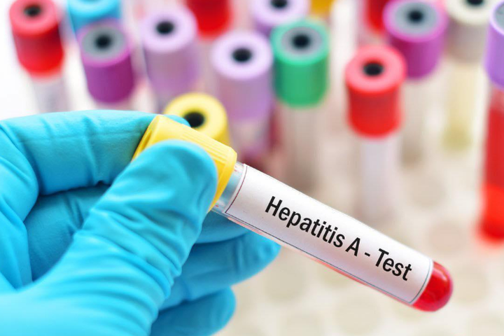 На Одещині четверо дітей захворіли на гепатит