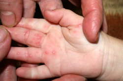 В Одесі через вірус Коксакі закрили на карантин класи