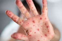 З початку року у Києві на кір захворіло понад 5,3 тис. осіб