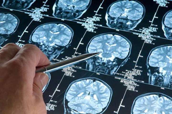 Медики назвали п’ять симптомів раку головного мозку