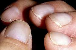 Названы четыре внешних признака, которые указывают на проблемы с сердцем