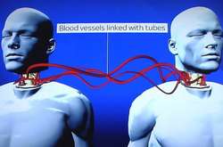 Першу пересадку мертвої людської голови на труп здійснив у 2017 році в Китаї італійський нейрохірург Серджіо Канаверо