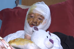 Дівчинка перебуває в лікарні з глибокими опіками обличчя, шиї та лівої руки