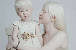 Сестры-альбиносы завораживают сеть своими фотографиями