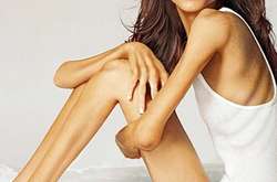 На Прикарпатті 18-річна дівчина померла від анорексії