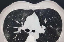 «Матовое стекло». Как коронавирус может убить вас