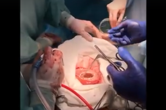 Вперше в Україні львівські військові кардіохірурги провели аутотрансплантацію серця