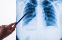 Названы признаки разных типов пневмонии: типичная, атипичная, «холодная»