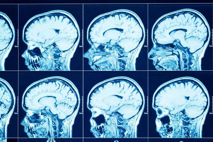 Вчені попереджають, що Covid-19 здатний вражати мозок